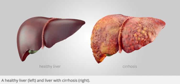 healthy liver vs cirrhosis